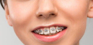Aparat ortodontyczny stały - 4 rzeczy, które warto wiedzieć